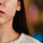 Get Rid of Acne with Ayurveda: Diet, Herbs, and Skincare