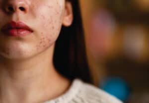 Get Rid of Acne with Ayurveda: Diet, Herbs, and Skincare